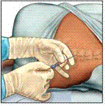 epidural