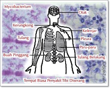 tuberkulosis tuberkulosis Setiap Nafas Adalah Bernilai Hentikan Tibi Sekarang!